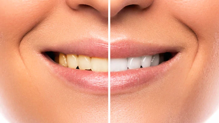 7 reasons to whiten your teeth
